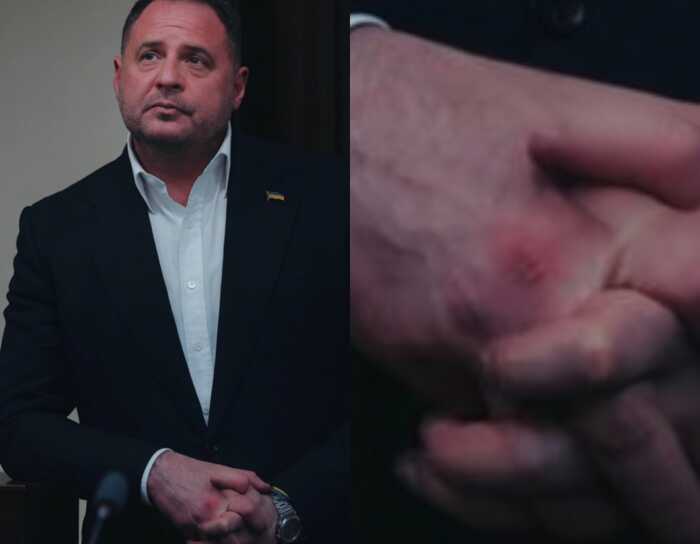 «Ніч була насиченою»: у мережі обговорюють дивні синці на руках Єрмака